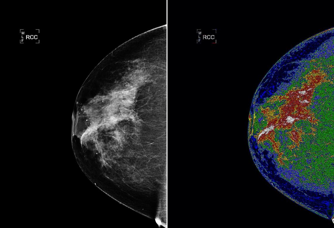 Mammograms MED-SEG