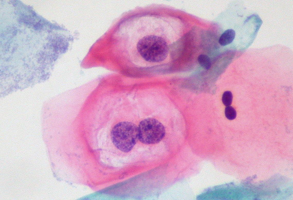 Low-Grade SIL with HPV Effect