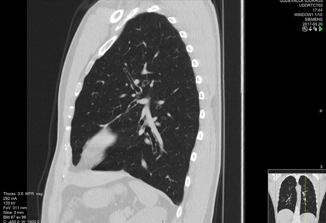 High-resolution computed tomograph of a normal thorax, sagittal plane
